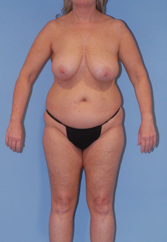 Abdominoplasty Before & After