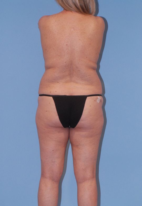 Abdominoplasty Before & After