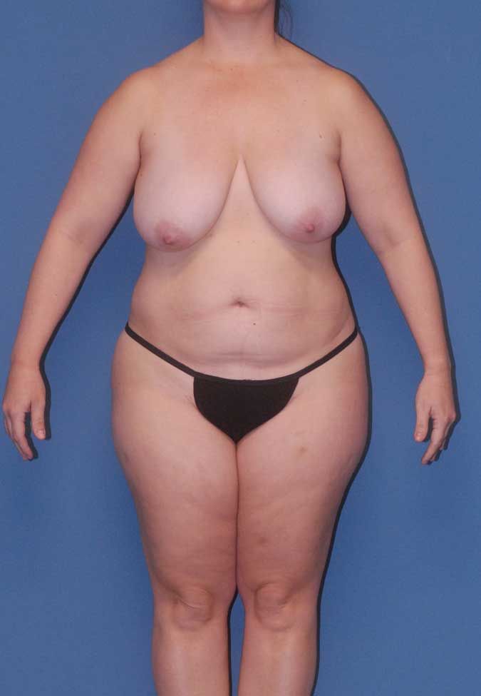 Abdominoplasty Before & After