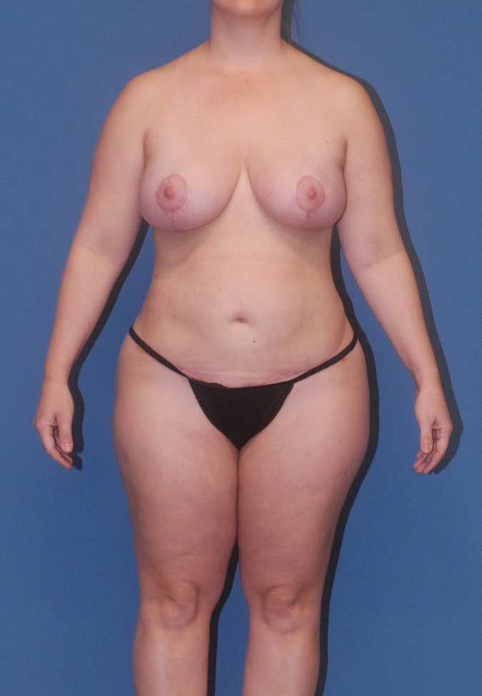 Abdominoplasty Before & After