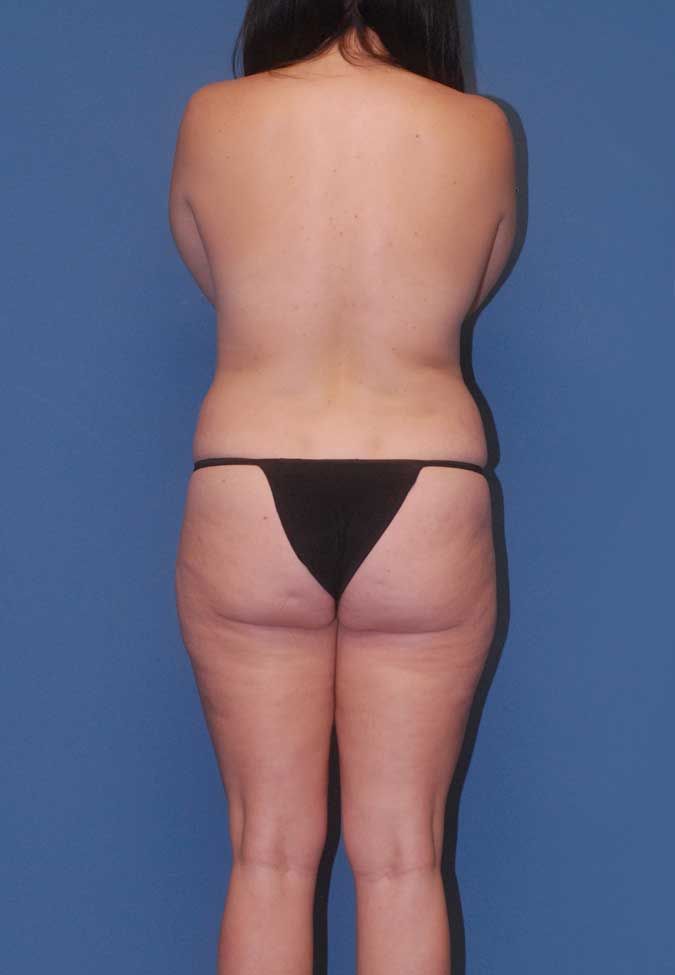 Abdominoplasty Before & After