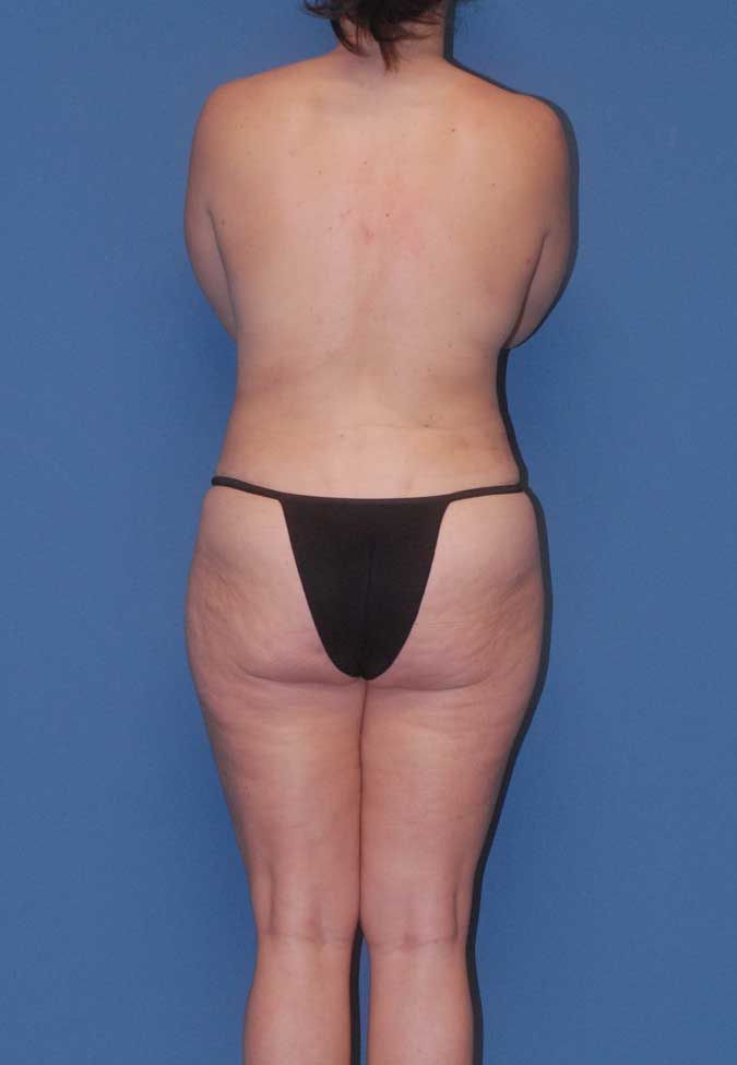 Abdominoplasty Before & After