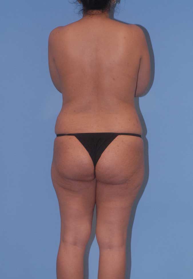 Abdominoplasty Before & After