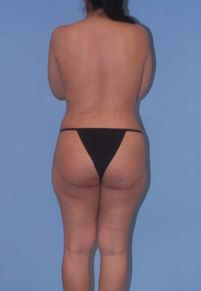 Abdominoplasty Before & After