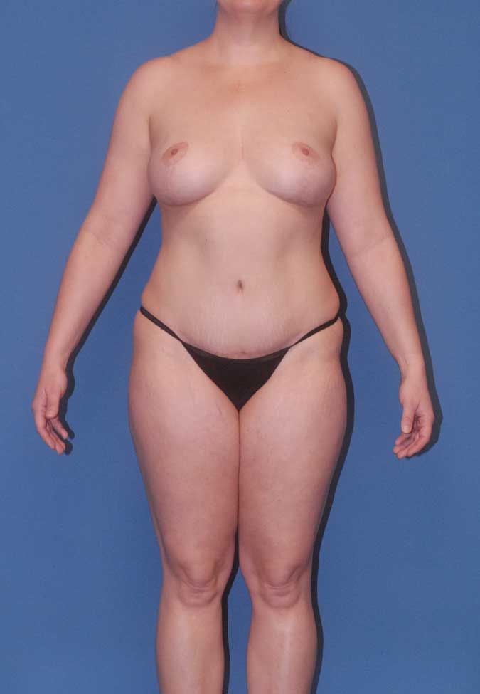 Abdominoplasty Before & After