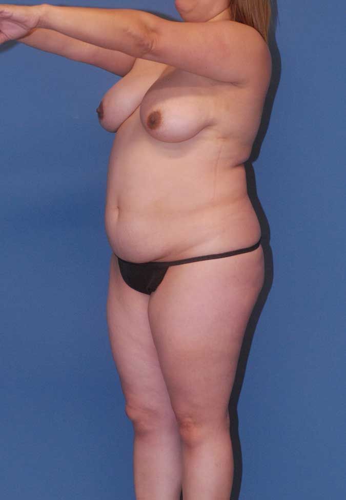 Abdominoplasty Before & After