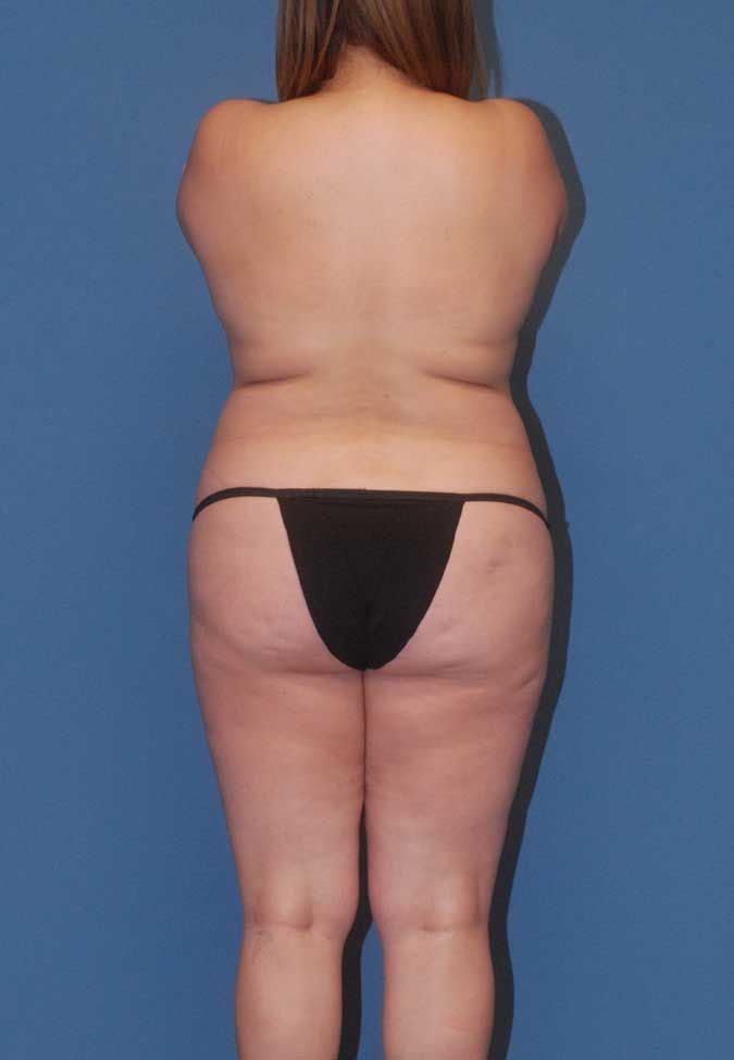 Abdominoplasty Before & After