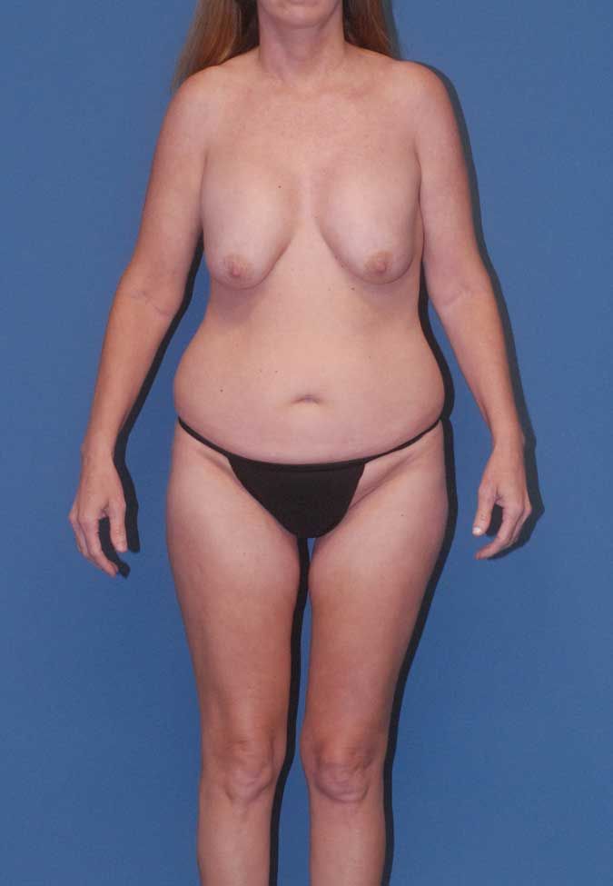 Abdominoplasty Before & After