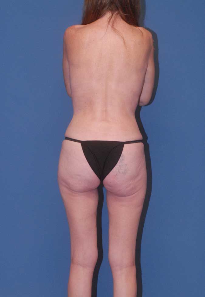 Abdominoplasty Before & After