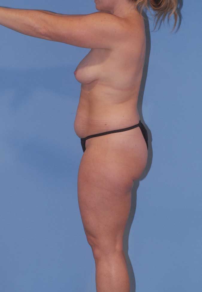 Abdominoplasty Before & After