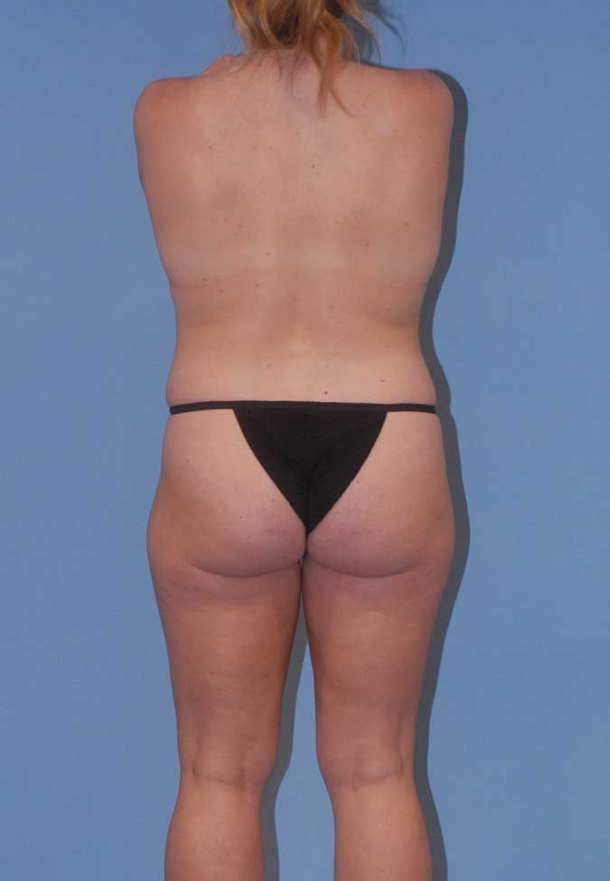 Abdominoplasty Before & After
