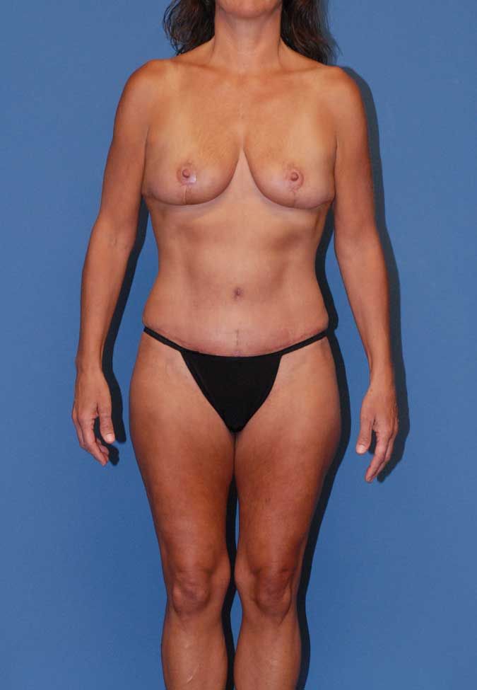 Abdominoplasty Before & After