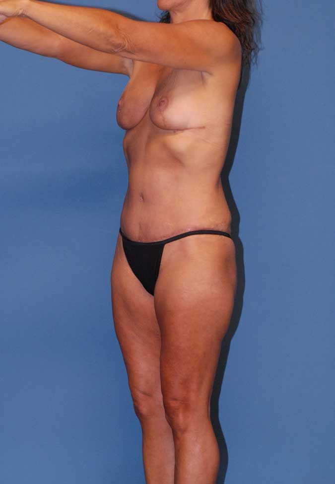 Abdominoplasty Before & After