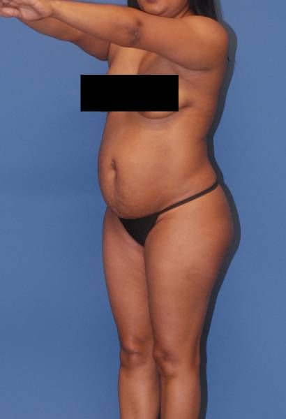 Abdominoplasty Before & After