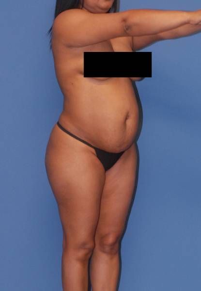 Abdominoplasty Before & After
