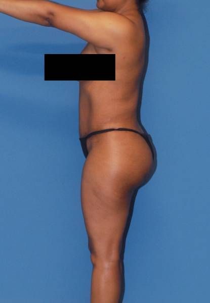 Abdominoplasty Before & After