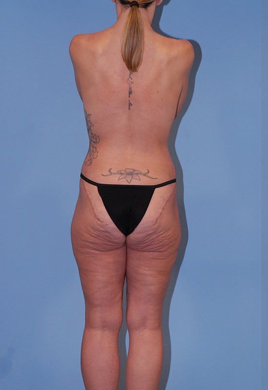 Abdominoplasty Before & After