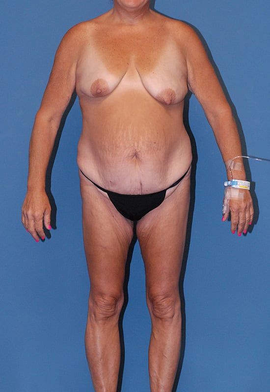 Abdominoplasty Before & After