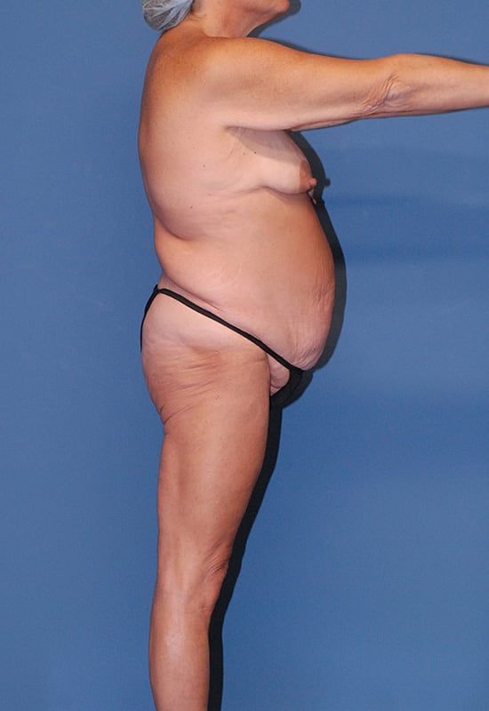 Abdominoplasty Before & After