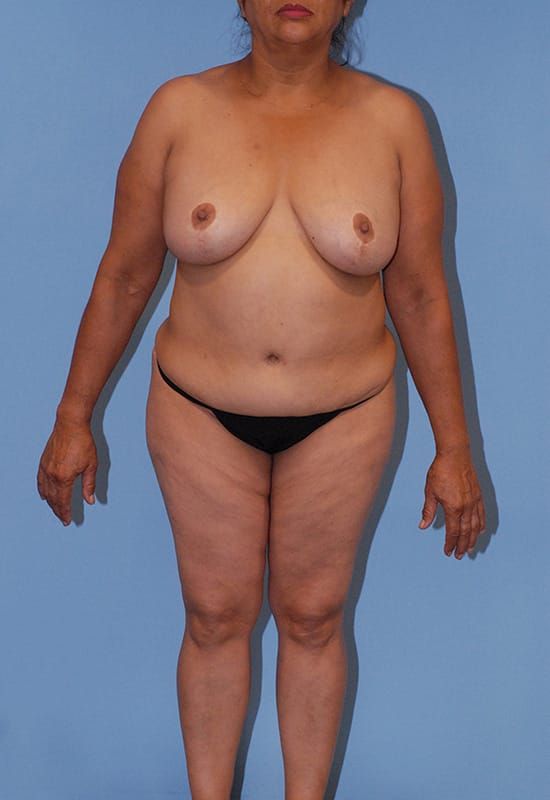 Abdominoplasty Before & After
