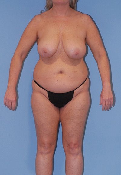 Abdominoplasty Before & After