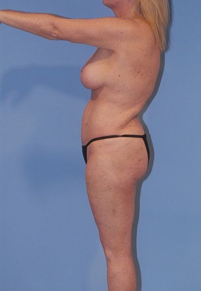 Abdominoplasty Before & After