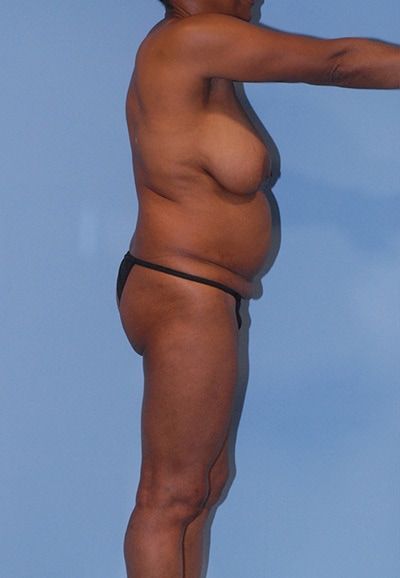 Abdominoplasty Before & After