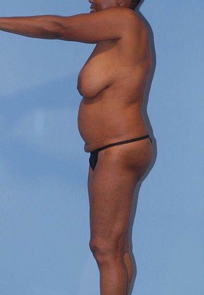 Abdominoplasty Before & After