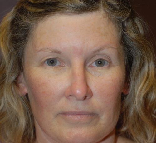 Brow Lift Before & After