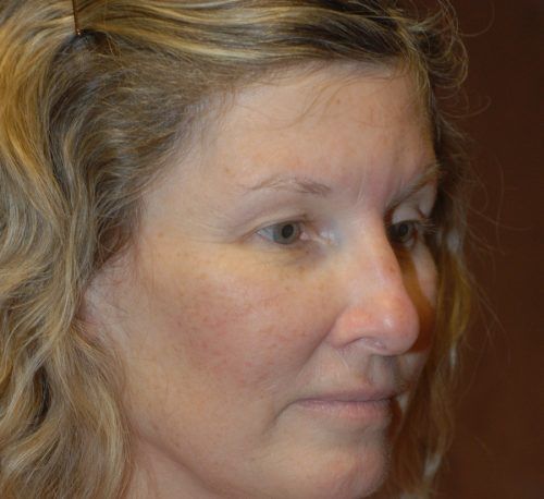 Brow Lift Before & After