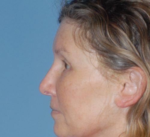 Brow Lift Before & After