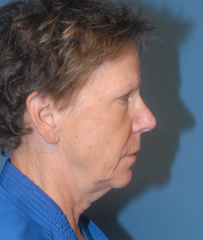 Brow Lift Before & After