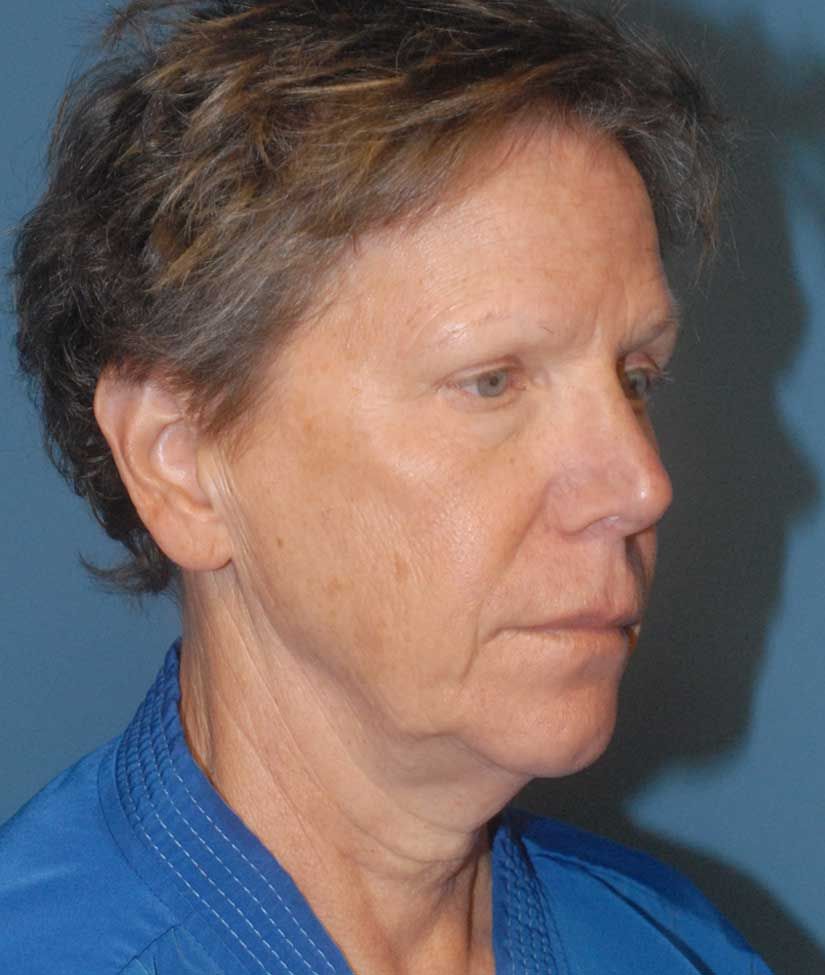 Brow Lift Before & After