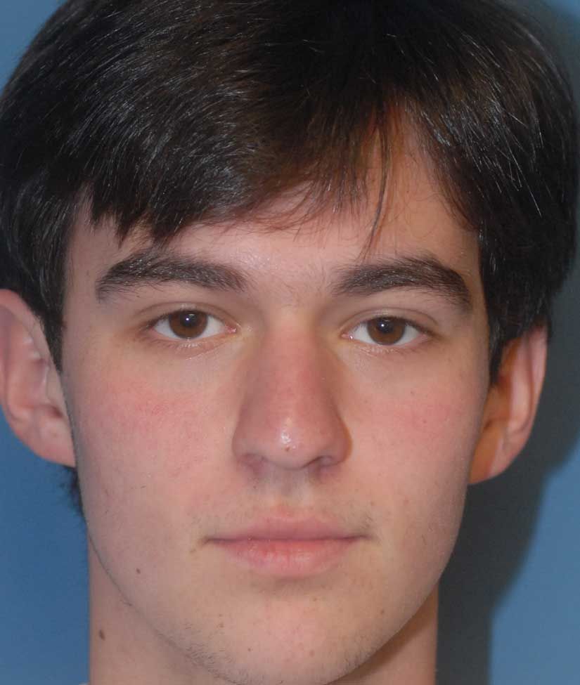 Rhinoplasty Before & After