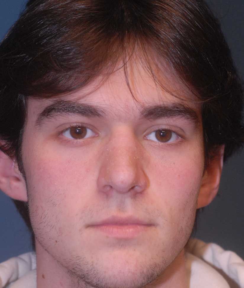 Rhinoplasty Before & After