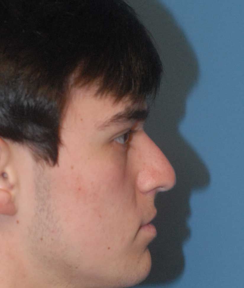 Rhinoplasty Before & After
