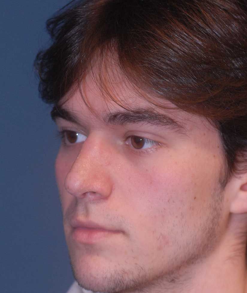 Rhinoplasty Before & After