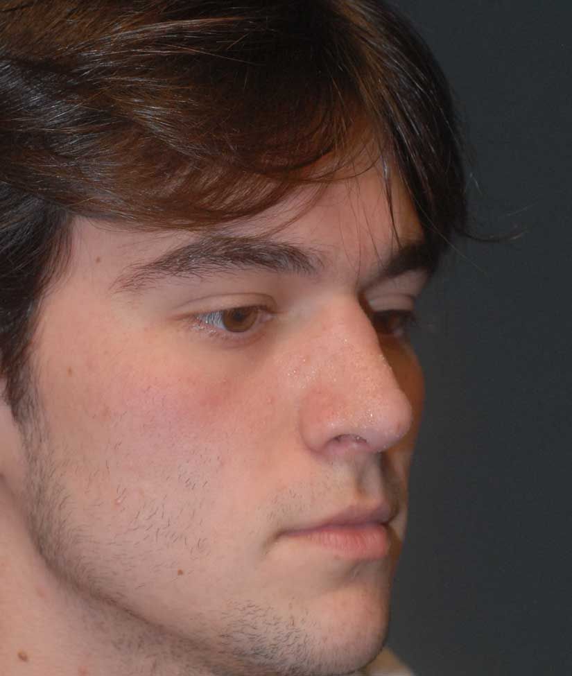 Rhinoplasty Before & After