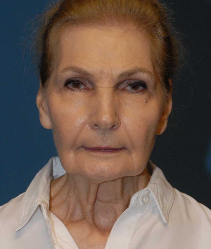 Facelift Before & After