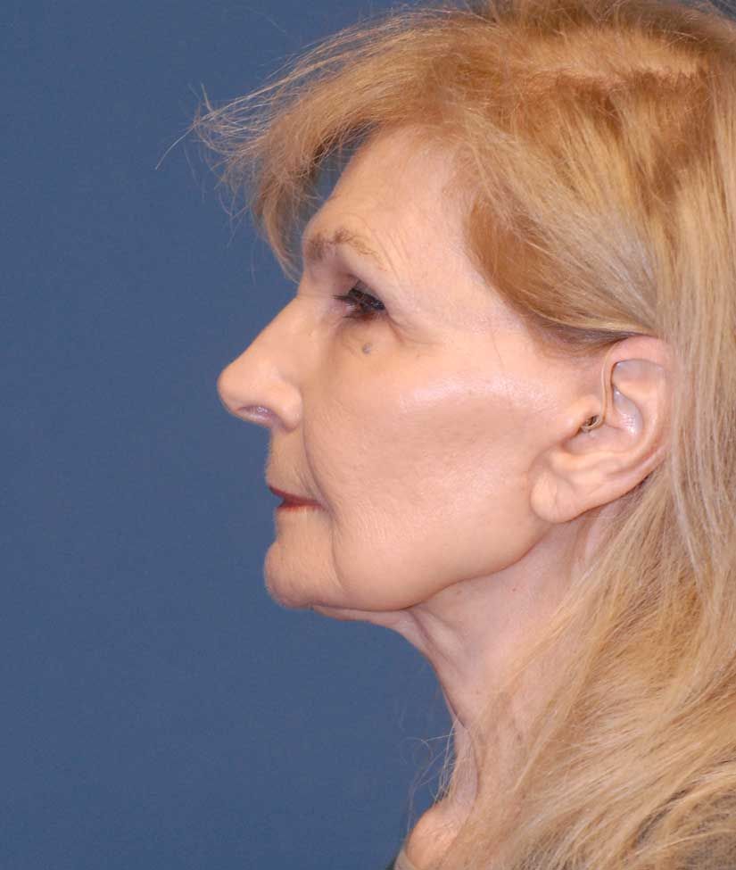 Facelift Before & After