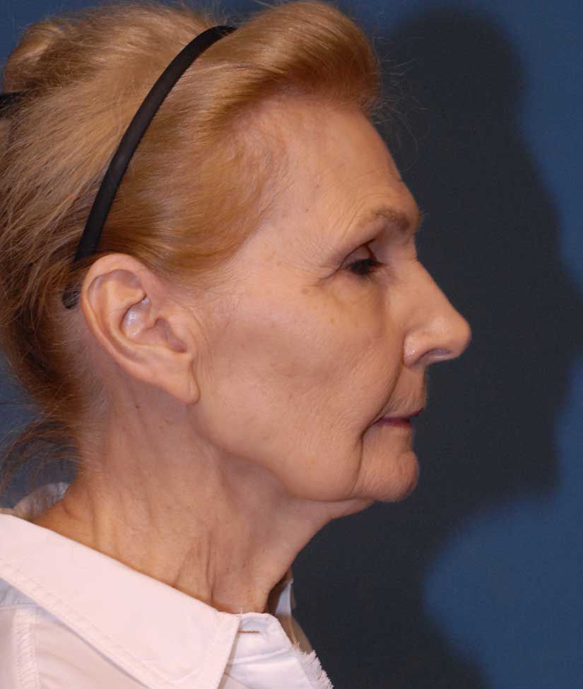 Facelift Before & After