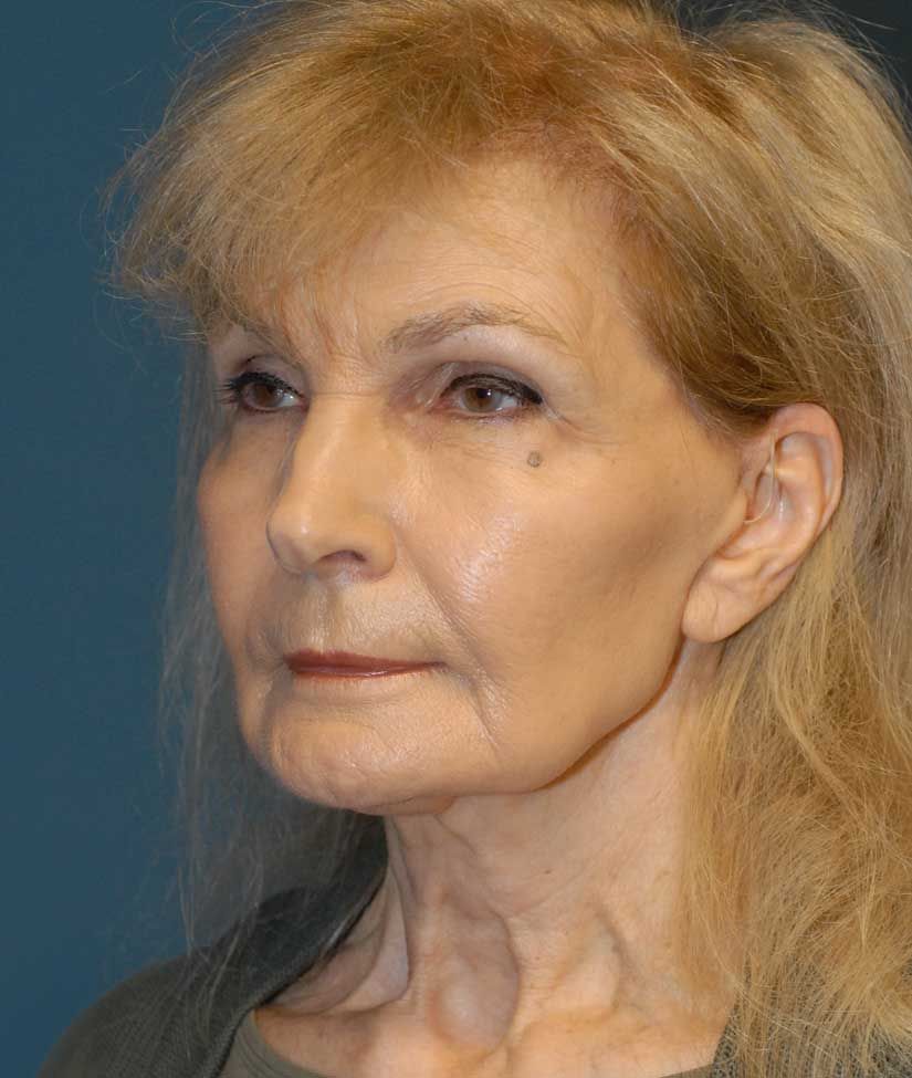 Facelift Before & After