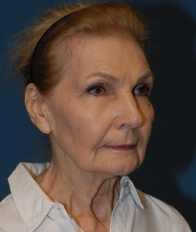 Facelift Before & After