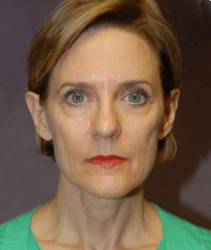 Facelift Before & After