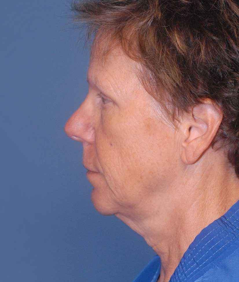 Facelift Before & After