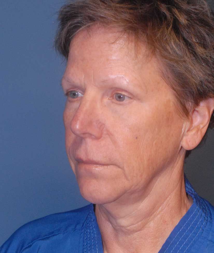 Facelift Before & After