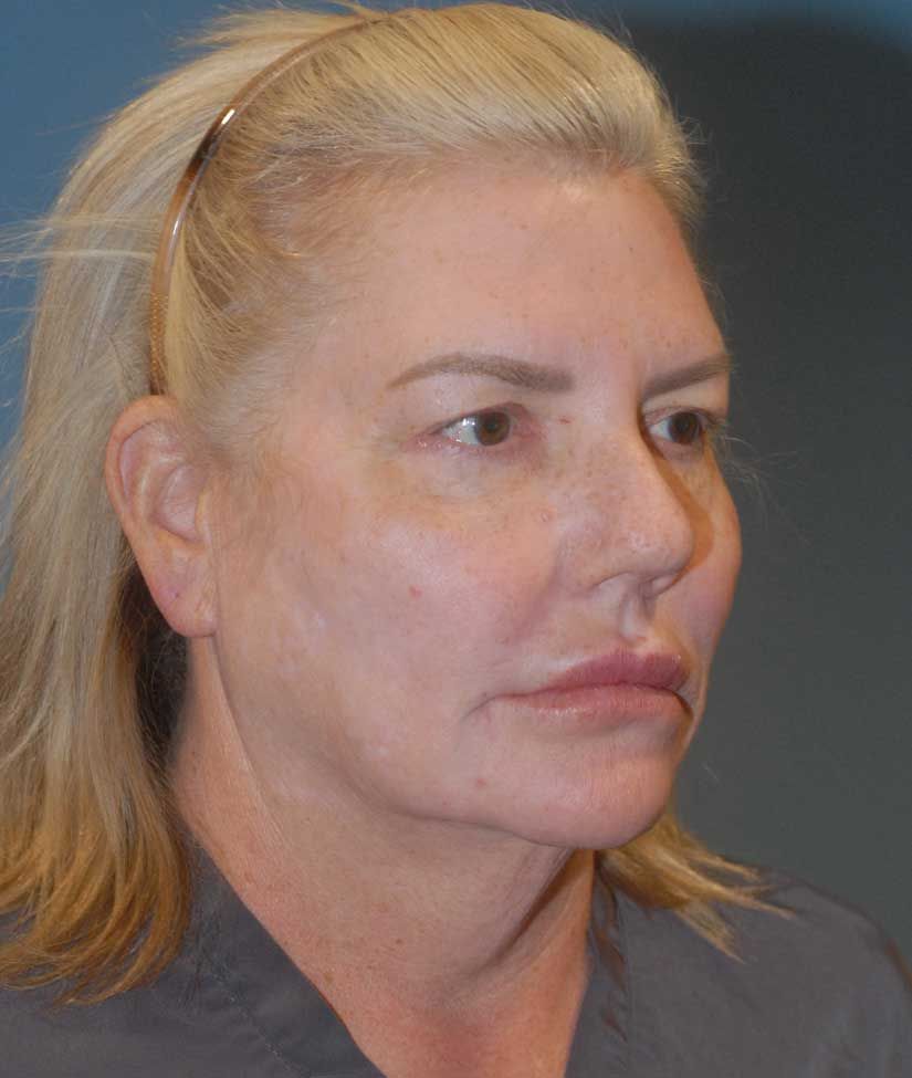 Facelift Before & After