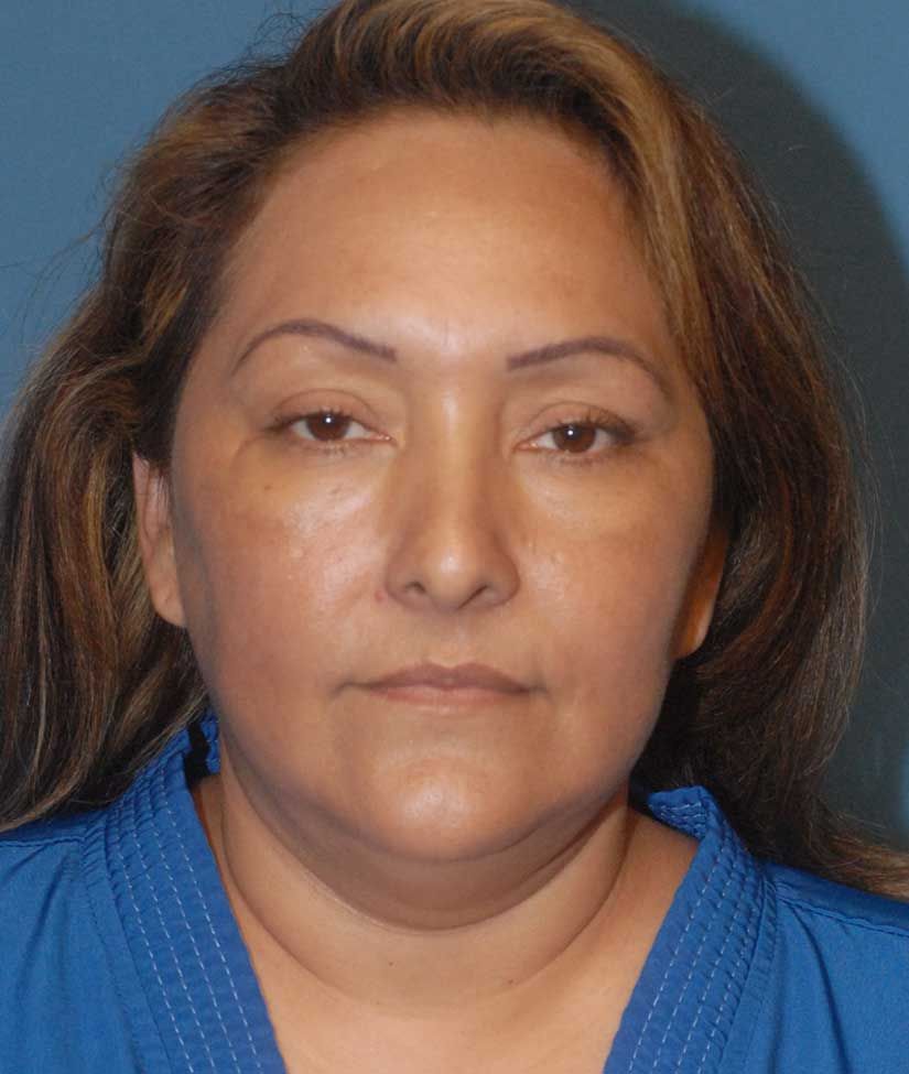 Facelift Before & After