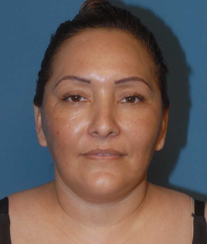 Facelift Before & After