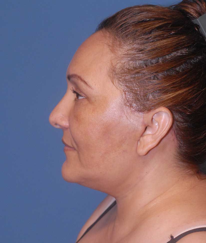 Facelift Before & After